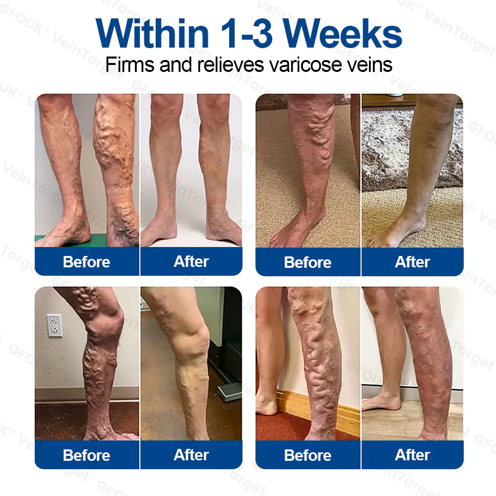🇬🇧💙👨‍⚕️✅GFOUK® VeinTarget Microneedle Patch⚡Instant Relief, Long-Term Results - Image 3