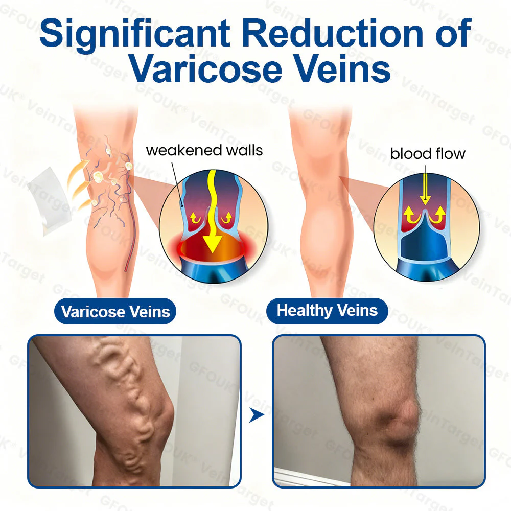🇬🇧💙👨‍⚕️✅GFOUK® VeinTarget Microneedle Patch⚡Instant Relief, Long-Term Results - Image 4