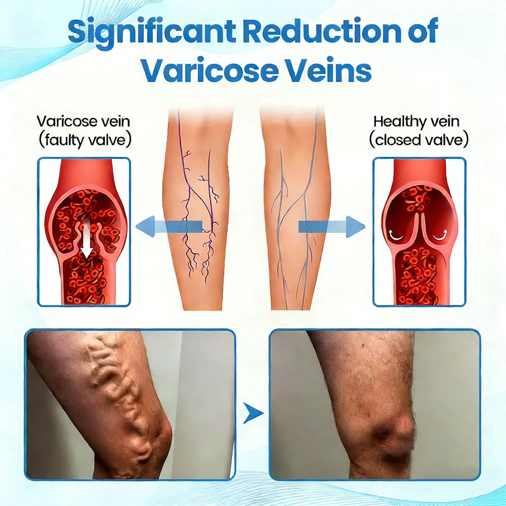 🇬🇧✅GFOUK® VascuCare Vein Healing Spray(Designed for Varicose veins, Spider veins, Deep vein Thrombosis, Chronic venous insufficiency, Venous ulcers, Thrombophlebitis and other venous issues) - Image 11