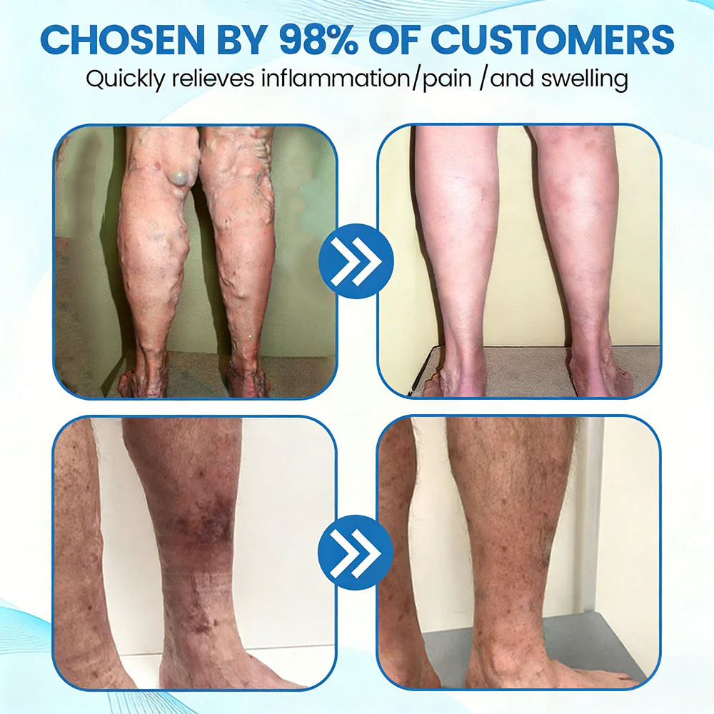 🇬🇧✅GFOUK® VascuCare Vein Healing Spray(Designed for Varicose veins, Spider veins, Deep vein Thrombosis, Chronic venous insufficiency, Venous ulcers, Thrombophlebitis and other venous issues) - Image 5