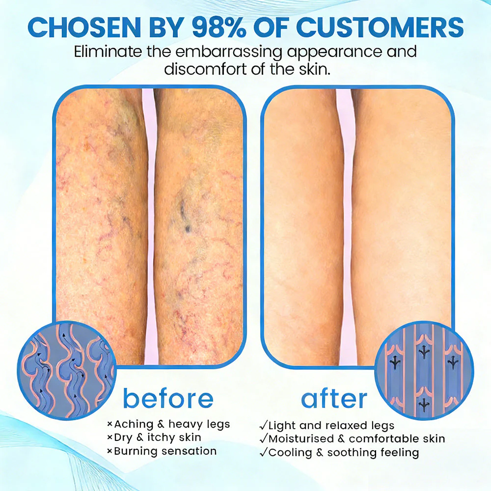 🇬🇧✅GFOUK® VascuCare Vein Healing Spray(Designed for Varicose veins, Spider veins, Deep vein Thrombosis, Chronic venous insufficiency, Venous ulcers, Thrombophlebitis and other venous issues) - Image 6