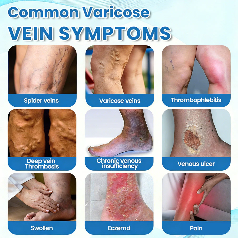 🇬🇧✅GFOUK® VascuCare Vein Healing Spray(Designed for Varicose veins, Spider veins, Deep vein Thrombosis, Chronic venous insufficiency, Venous ulcers, Thrombophlebitis and other venous issues) - Image 8